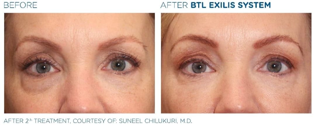 Exilis Ultra Skin Tightening Before & After Photos Patient 34